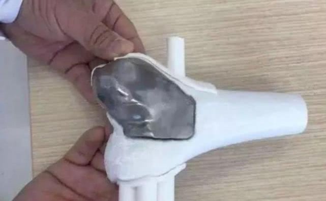 交大一附院長安區(qū)醫(yī)院完成首例3D打印修復骨腫瘤患者膝關節(jié)缺損